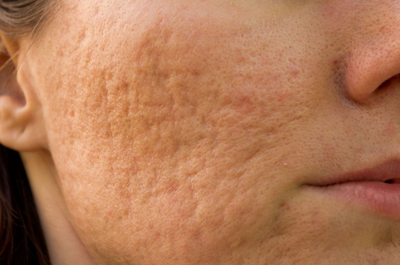 How to Treat (and Avoid) Acne Scars