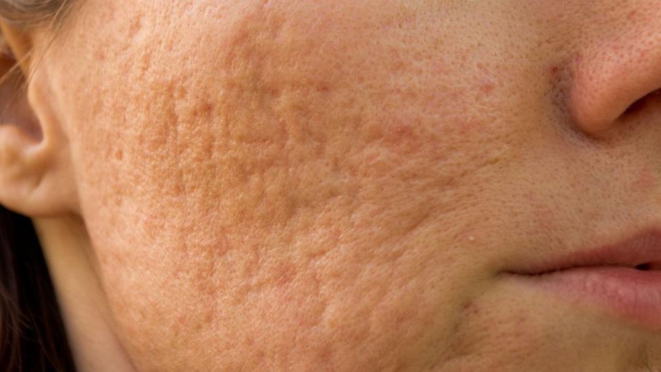 How to Treat (and Avoid) Acne Scars